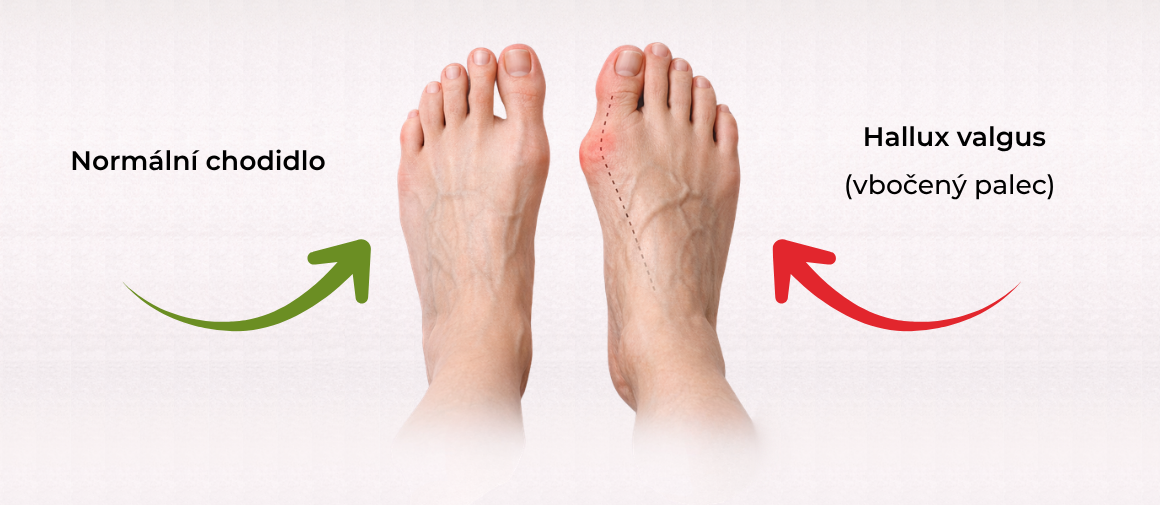 Vbočený palec Hallux Valgus O co se jedná